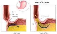 چگونه ریفلاکس معده را درمان کنیم